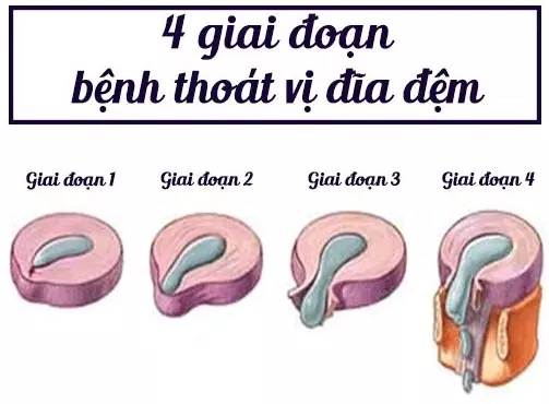 thoat-vi-dia-dem-bao-gom-4-giai-doan